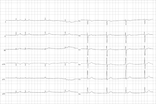 Sick sinus syndrome